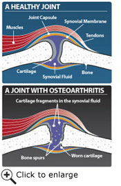 Osteoarthritis Information