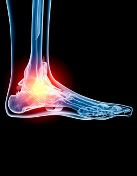 Osteoarthritis Feet