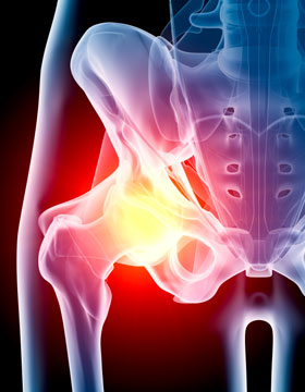 Osteoarthritis Hip