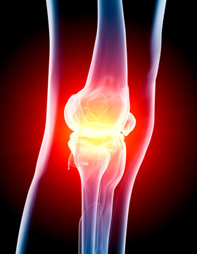 Osteoarthritis Knee