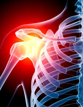 Osteoarthritis Shoulder