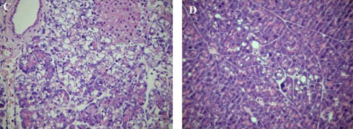 Acute Pancreatitis