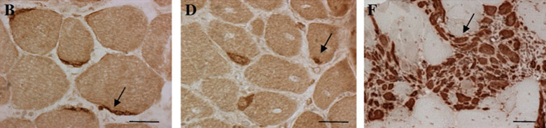 Duchenne's muscular dystrophy